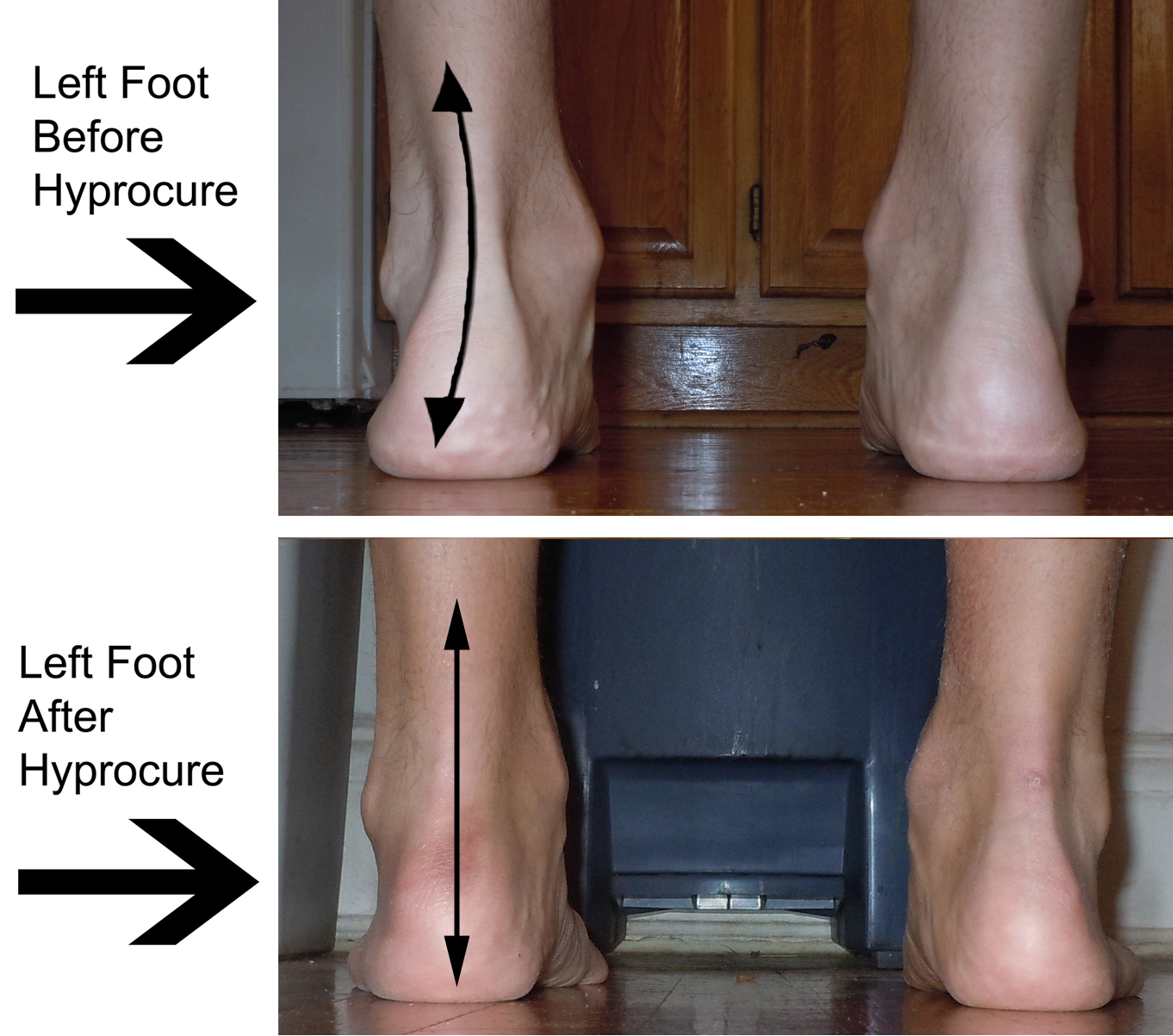 What kind of surgery is available for flat feet?
